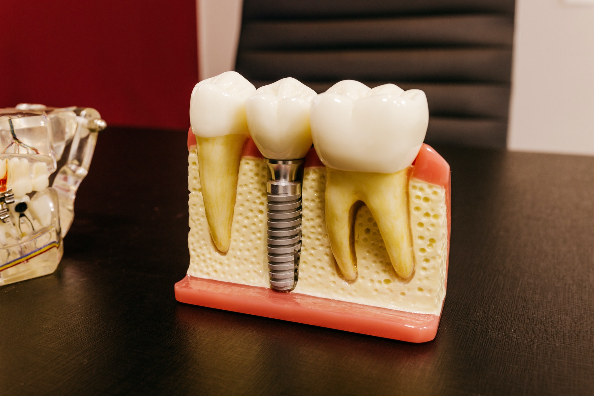 Model of a dental implant on a table in a clinic