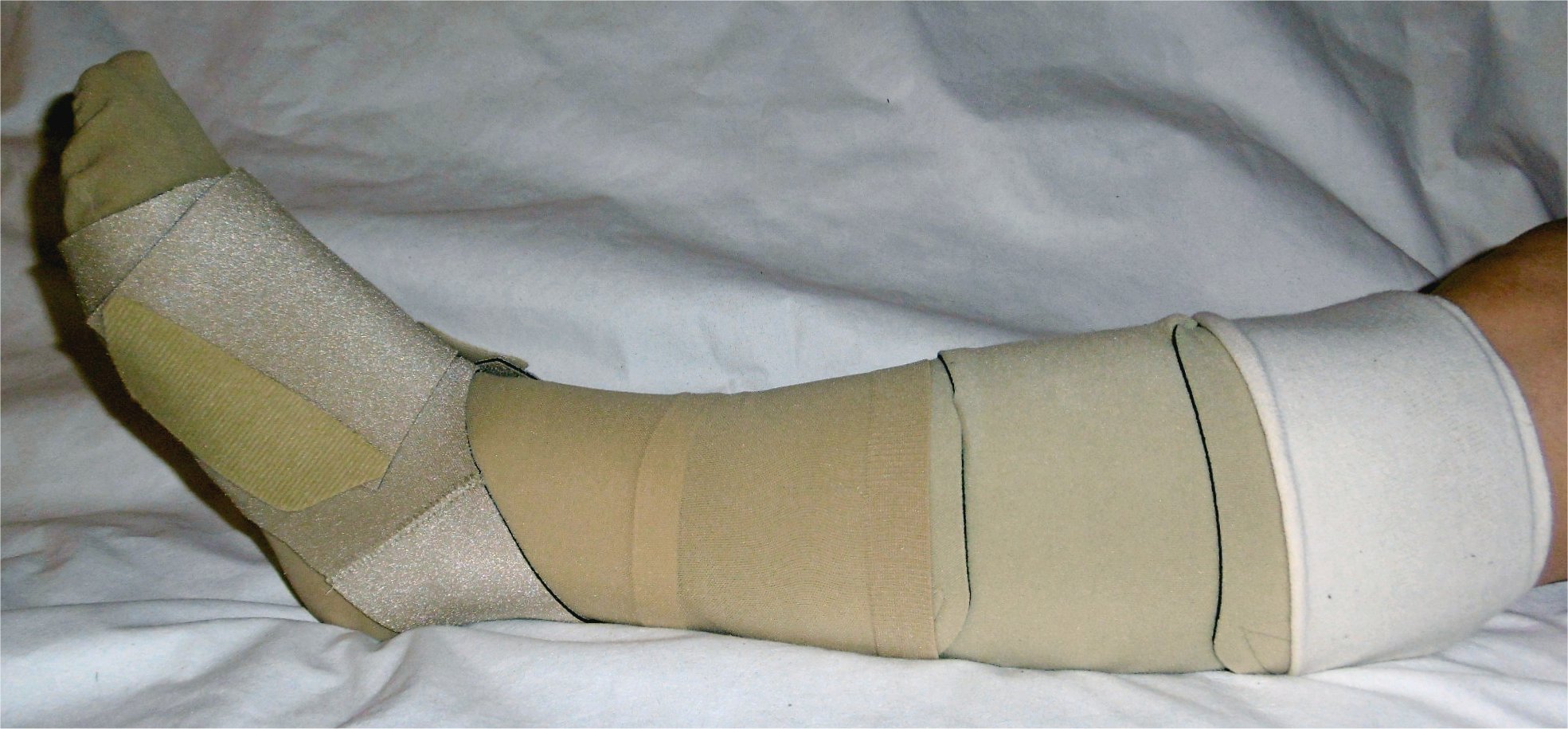 Compression therapy for lymphedema