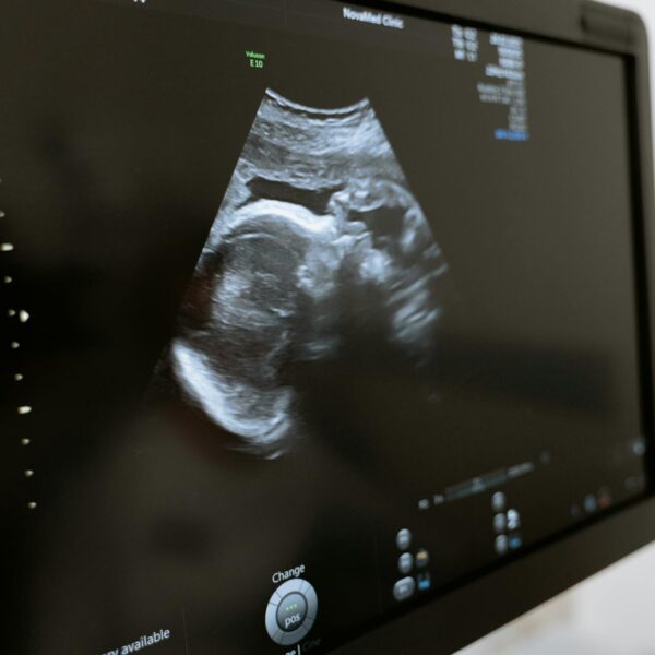 Baby scan on a monitor
